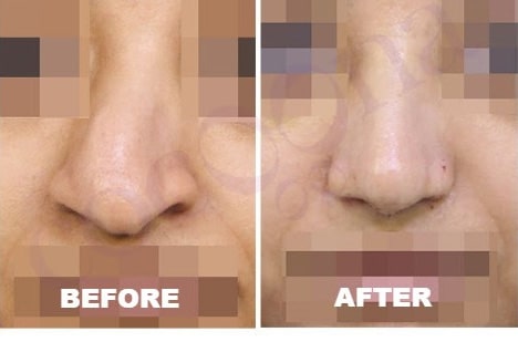 cocoona.gr8services.ae-successstory-nosereconstruction-nose.jpg