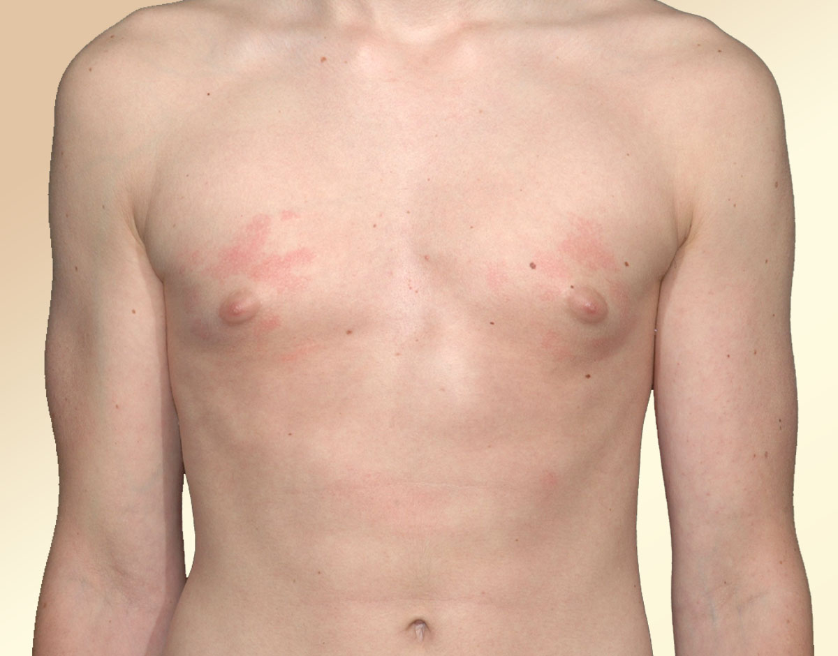 Risks and Side Effects Gynecomastia Surgery