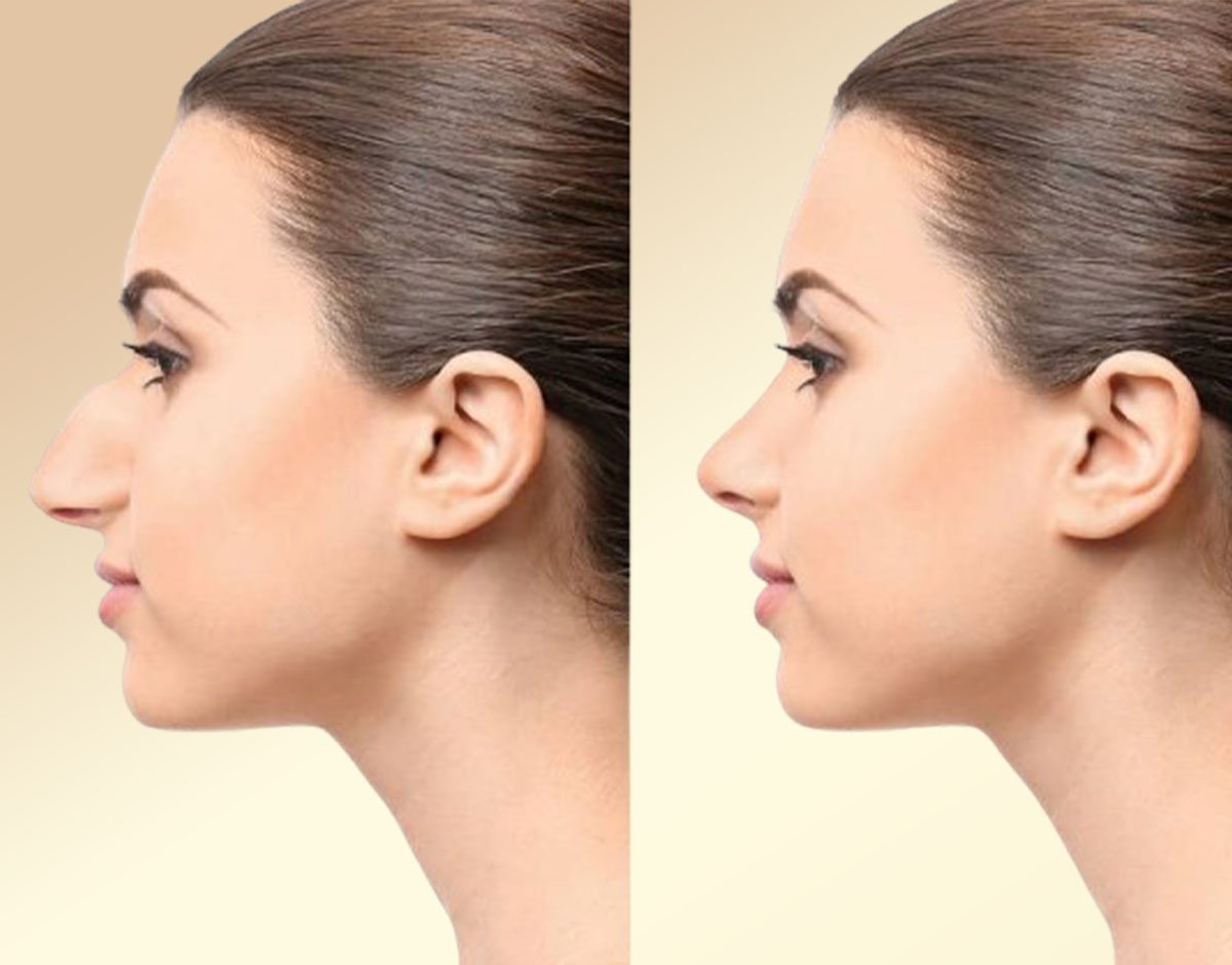 Benefits of Nose Surgery