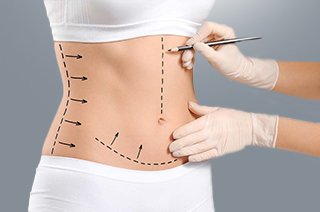 Liposuction Surgery