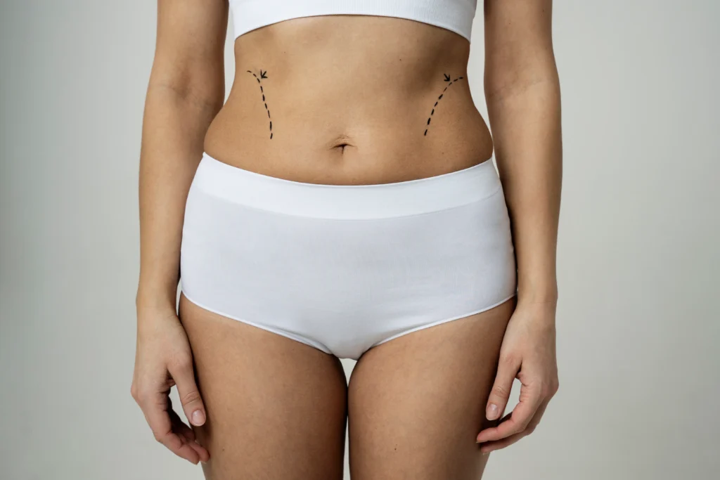 Front view of a woman’s midsection with black surgical marker traces on the waist and flanks, illustrating the targeted zones for a Lipo Abdominoplasty procedure.