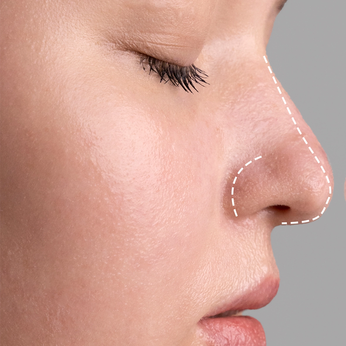 Profile view of a patient's nose with white surgical dotted lines illustrating the Rhinoplasty Tip Reshaping planning process.