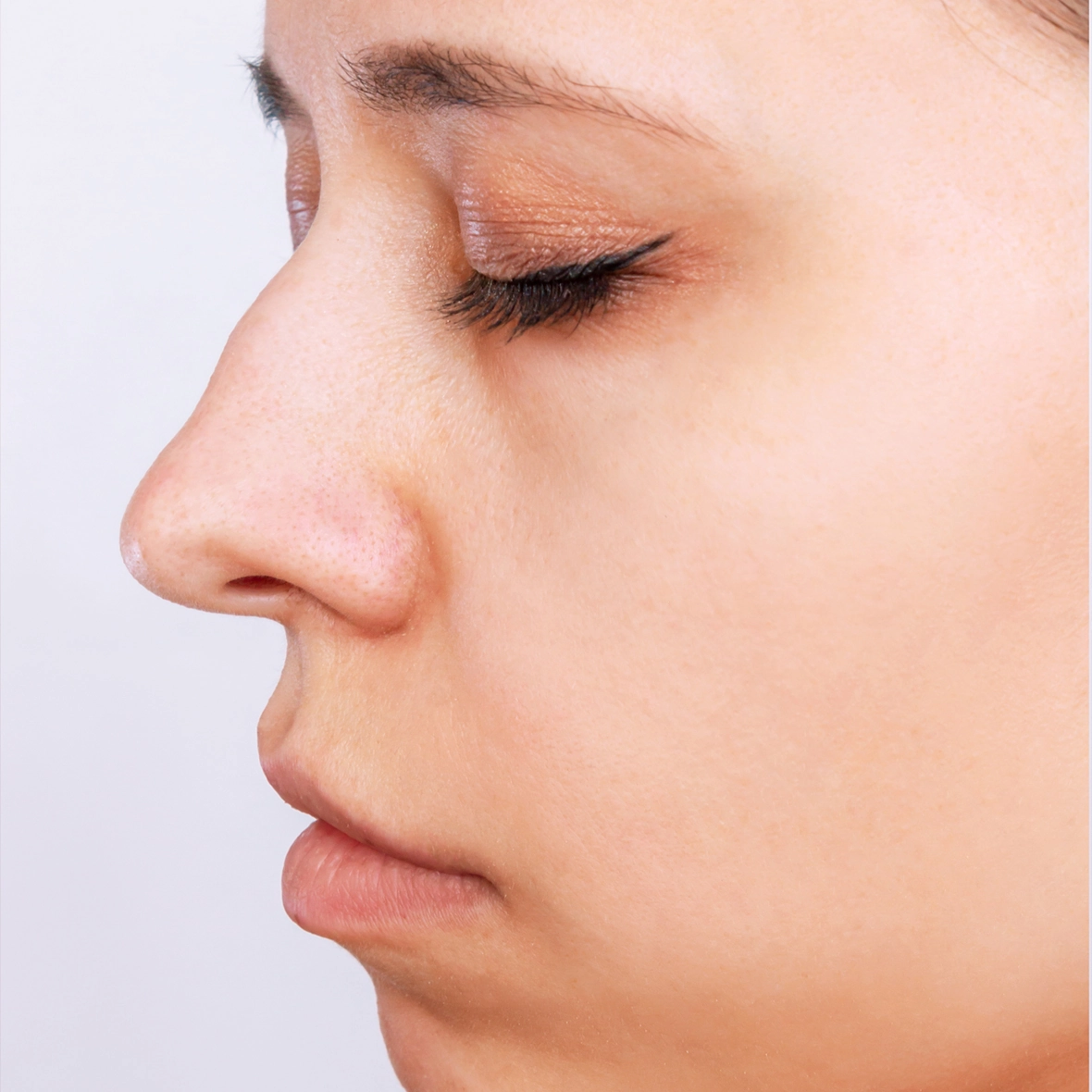 A profile view of a patient’s nose showing external signs of a deviated septum before a Septoplasty procedure.