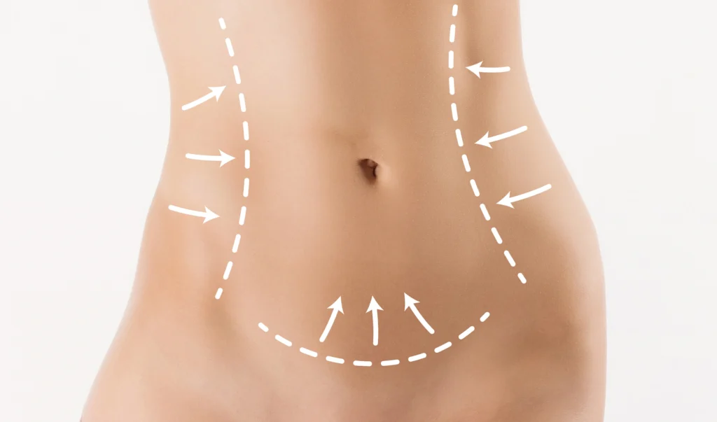 Illustration of belly liposuction in Dubai with white dashed lines and arrows on the waist and lower abdomen.