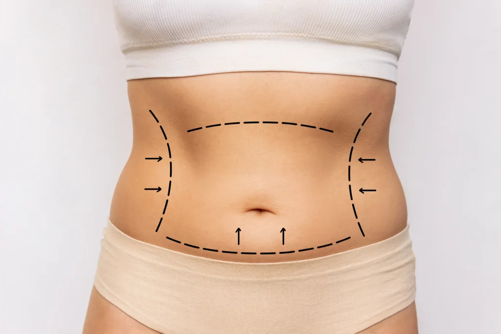 Close-up of a patient's midsection with black dashed surgical markings for belly liposuction in Dubai.