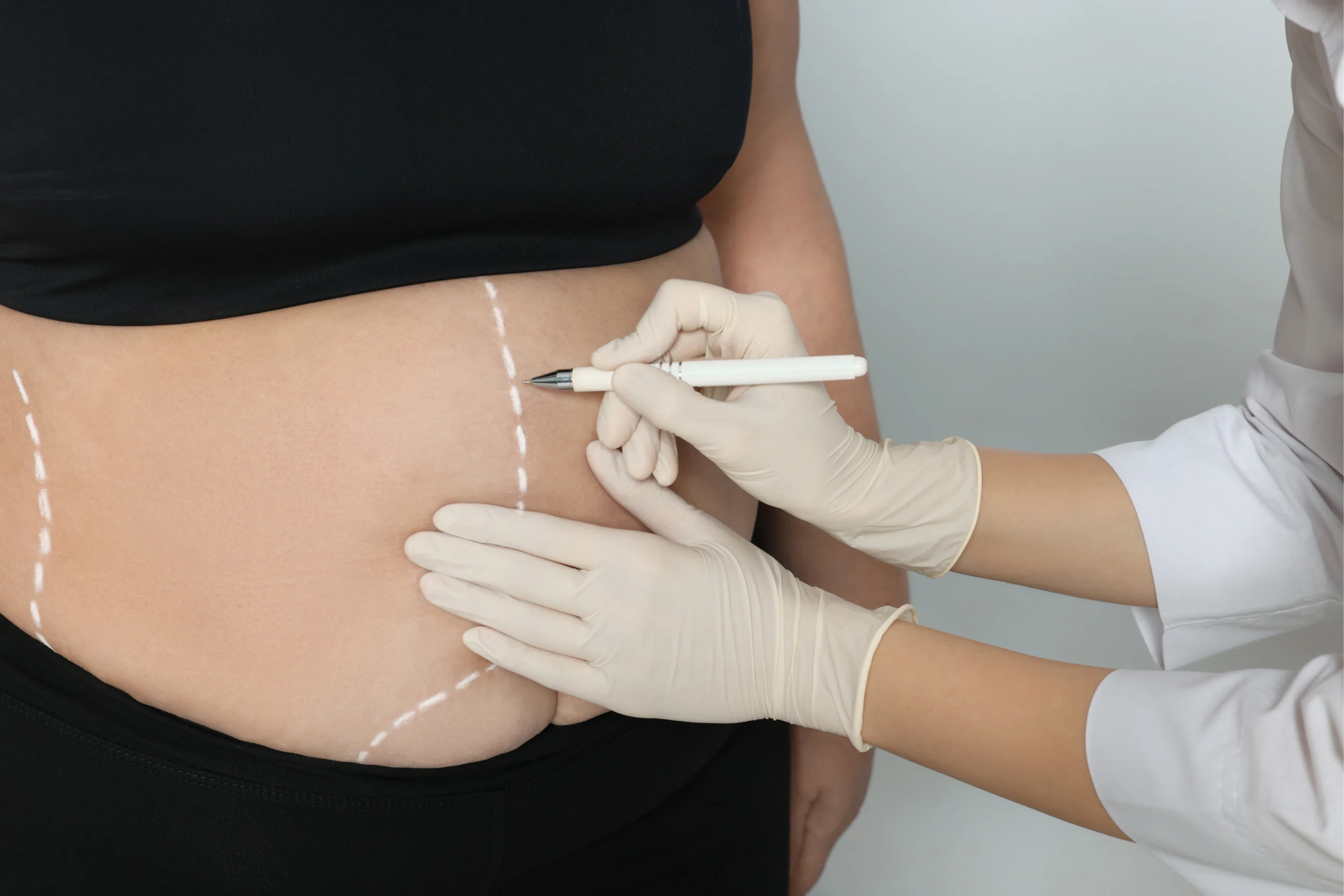 Surgical markings for a mommy makeover abdominoplasty Dubai to address postpartum musculoaponeurotic laxity.
