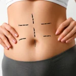 Assessment of abdominal wall structural integrity during the late-stage maturation phase of Tummy Tuck Recovery: Getting Back to Jeans After Abdominoplasty.