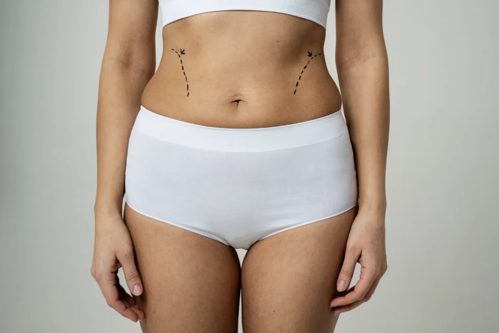 Front view of a woman with black dashed marker lines on her waist for belly liposuction in Dubai candidacy.