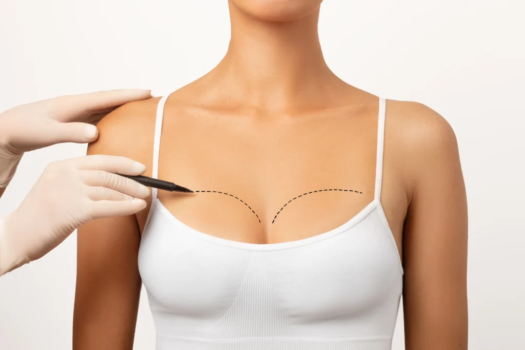 Surgeon using a marker to draw pre-operative lines for a breast implant in Dubai on a patient's chest.