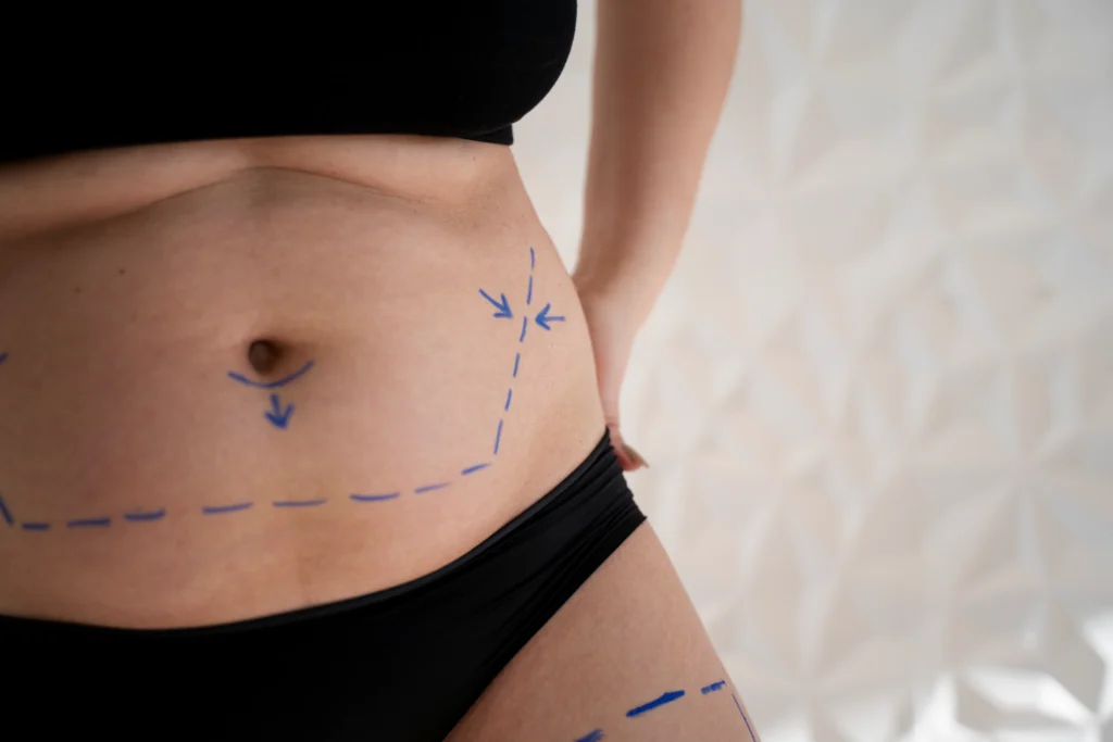 Close-up of blue surgical markings on a woman's abdomen and hip, identifying a candidate for stomach liposuction in Dubai.
