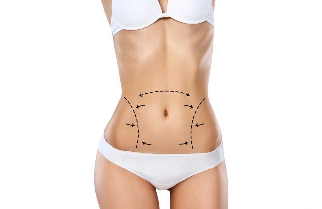 Preoperative surgical markings for liposuction in Dubai targeting the abdominal wall and lateral flanks.