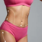 Clinical mapping of the suprapubic and umbilical regions to differentiate between a Mini vs. Full Abdominoplasty in Dubai.