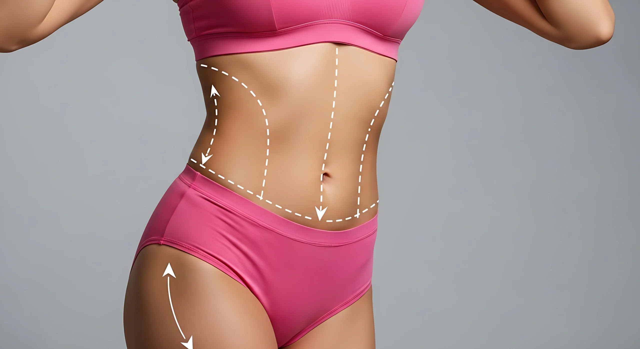 Clinical mapping of the suprapubic and umbilical regions to differentiate between a Mini vs. Full Abdominoplasty in Dubai.