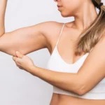 Clinical evaluation of triceps-level dermatochalasis and lipodystrophy for Arm Lift vs Liposuction in Dubai.