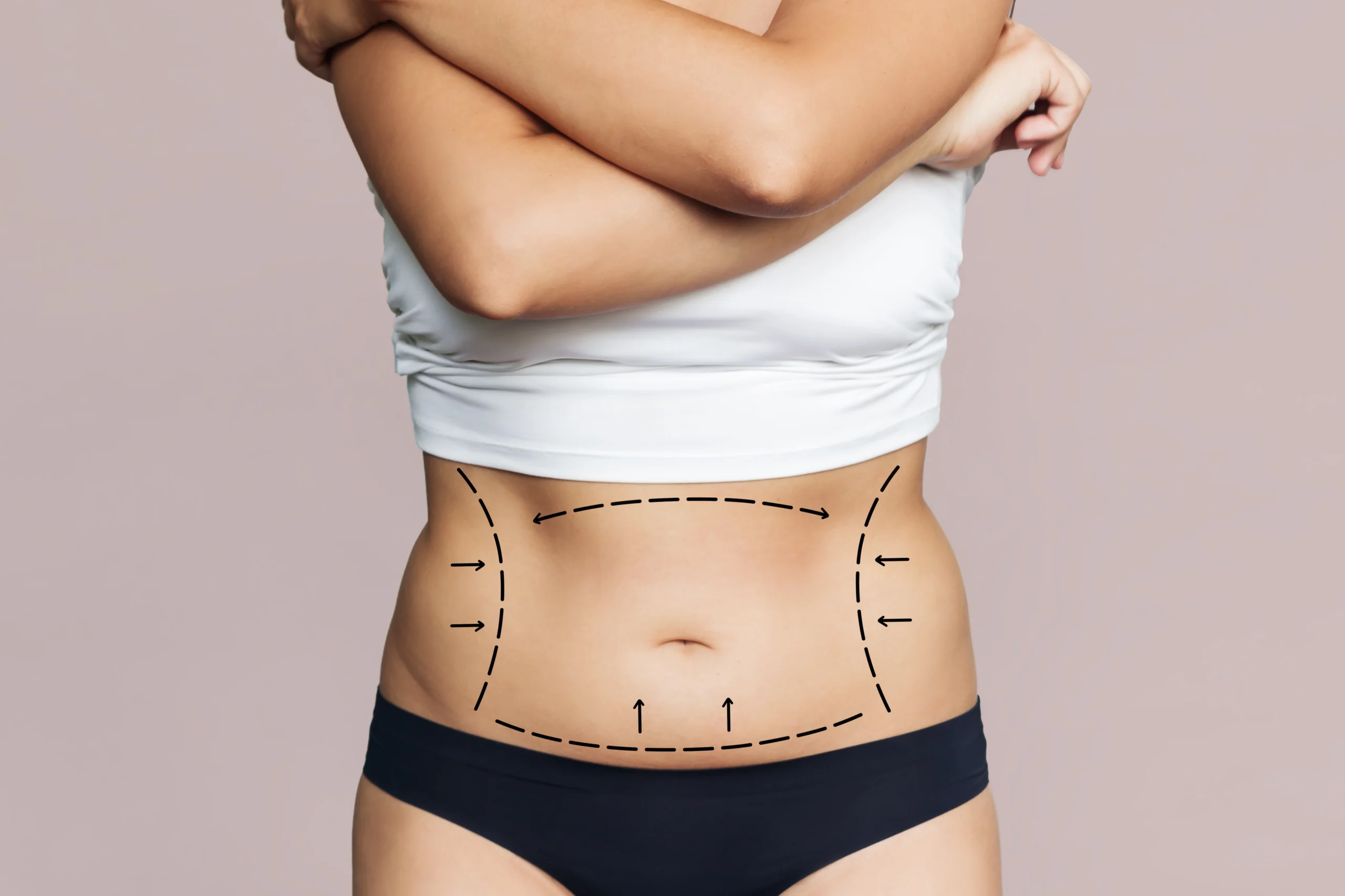 Clinical evaluation of abdominal circumference and dermal laxity for Abdominoplasty in Dubai for Mothers.