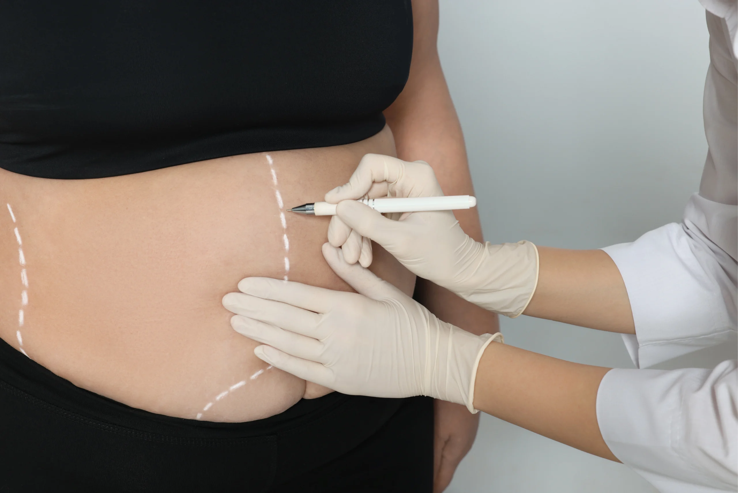 Comprehensive anatomical marking for a Mommy Makeover with Tummy Tuck Dubai targeting rectus diastasis and dermatochalasis.