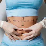 Surgical markings on the anterior abdominal wall for rectus diastasis repair and Before and After Abdominoplasty Surgery in Dubai.