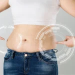 Clinical monitoring of a low-transverse suprapubic incision for Scar Management After Abdominoplasty in Dubai.