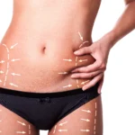 Anatomical marking of the abdominal panniculus to identify the best candidate for abdominoplasty in dubai.