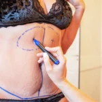 Preoperative marking for combined lipofilling and dermolipectomy to illustrate the Tummy Tuck with Liposuction: Benefits in Dubai.