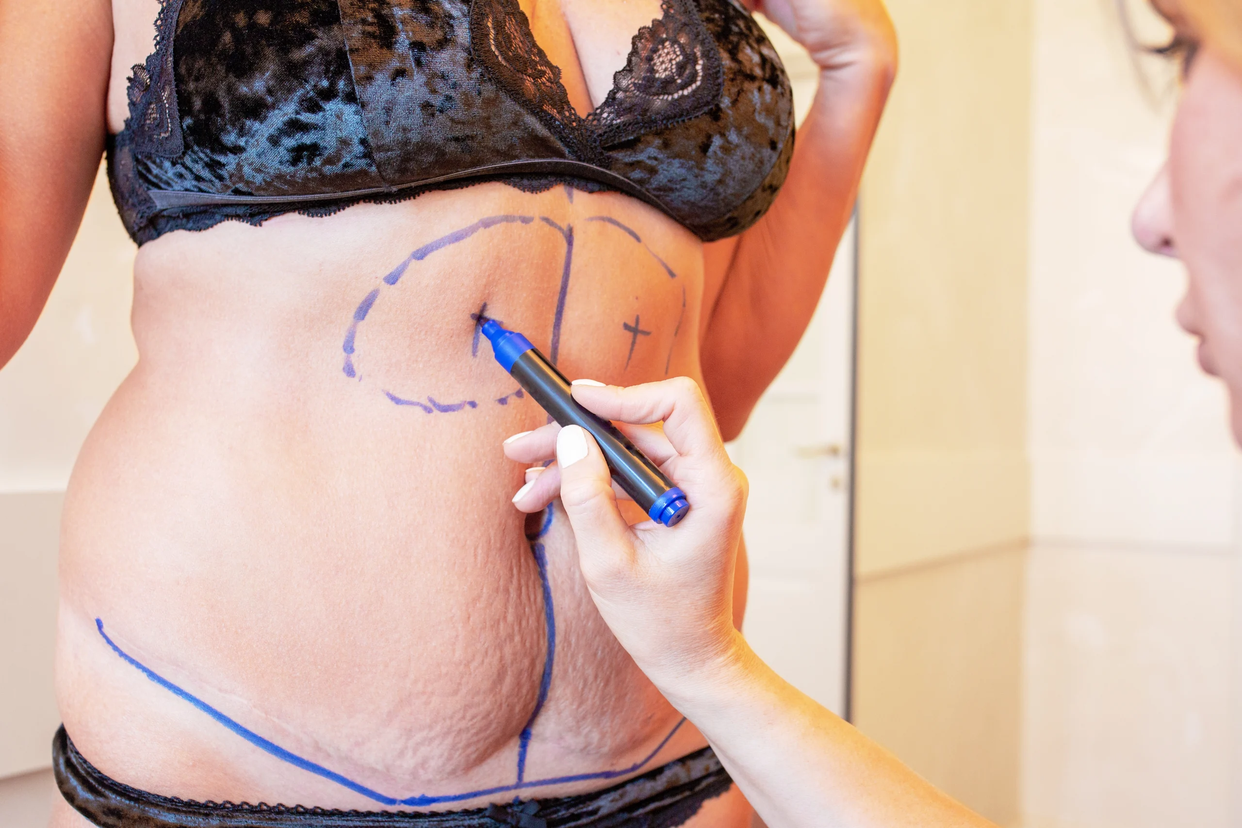 Preoperative marking for combined lipofilling and dermolipectomy to illustrate the Tummy Tuck with Liposuction: Benefits in Dubai.