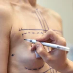 Clinical topographical markings on the mammary envelope to evaluate Is Breast Augmentation in Dubai Safe.