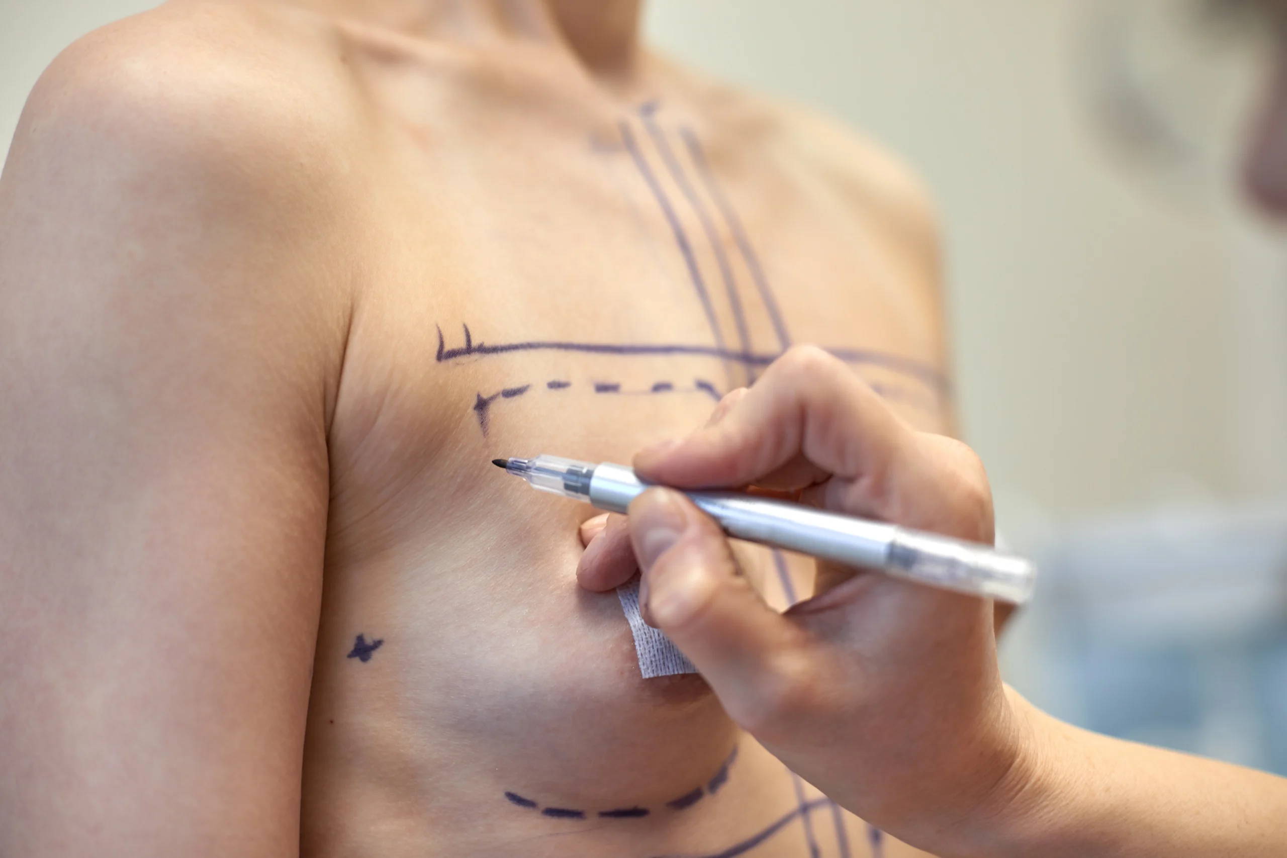 Clinical topographical markings on the mammary envelope to evaluate Is Breast Augmentation in Dubai Safe.