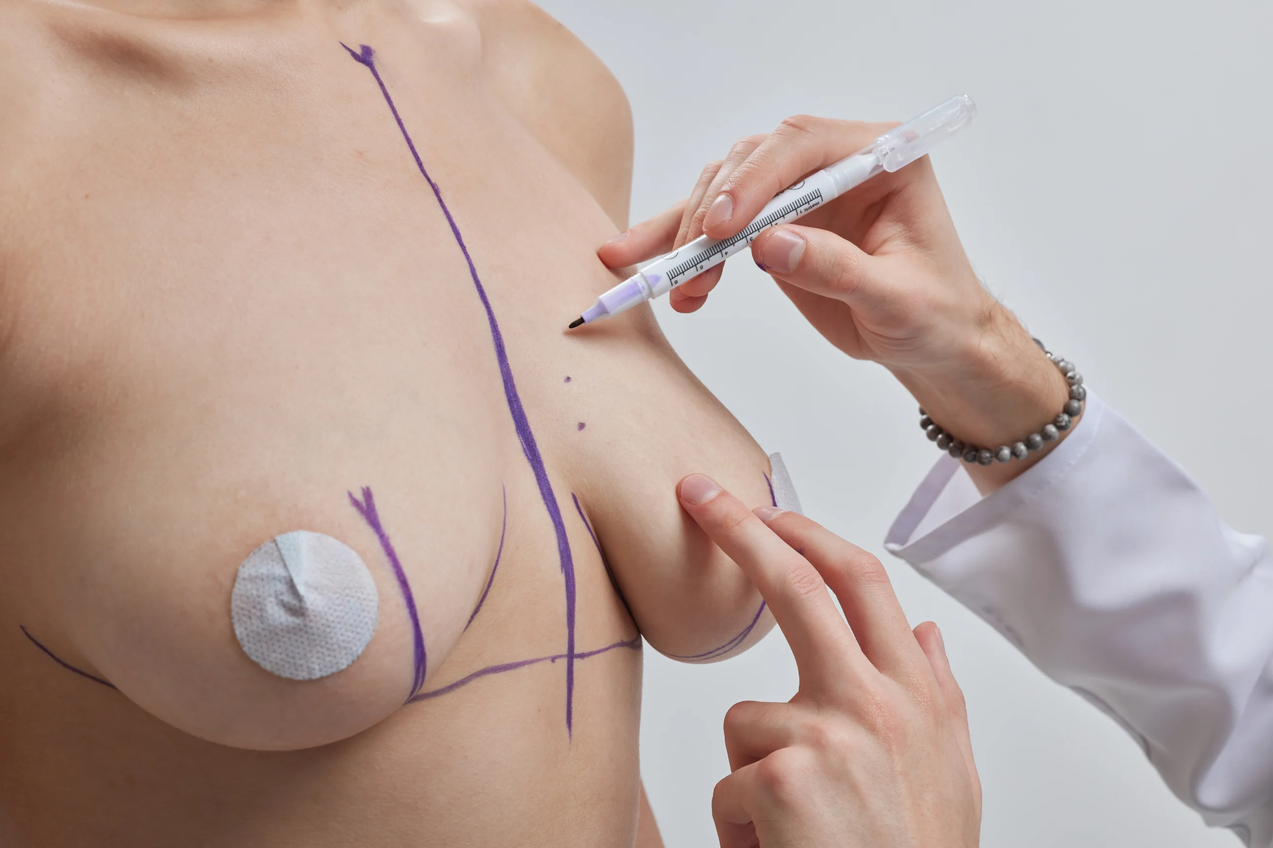 Topographical delineation of the mammary envelope to facilitate Natural-Looking Breast Augmentation in Dubai.
