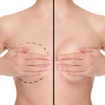 Anatomical comparison of preoperative markings vs. postoperative projection for the Best Breast Augmentation Techniques in Dubai.