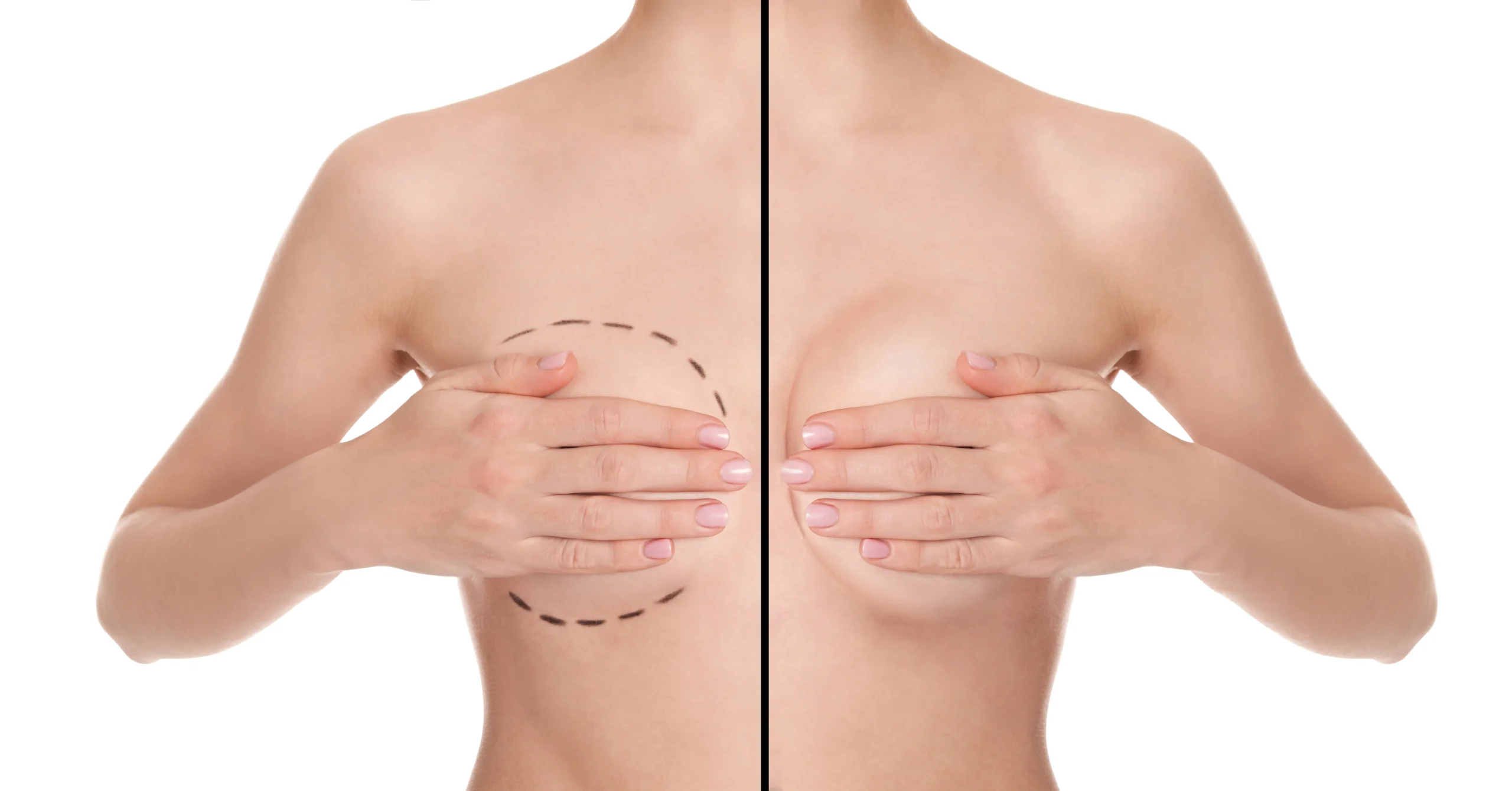 Anatomical comparison of preoperative markings vs. postoperative projection for the Best Breast Augmentation Techniques in Dubai.