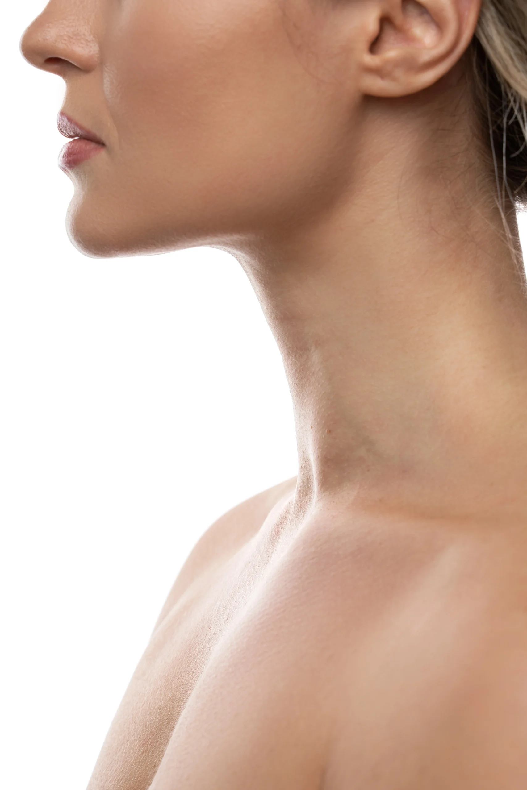 Lateral profile of the cervical and submental region, illustrating the anatomical landscape required for different types of Chin Liposuction in Dubai.