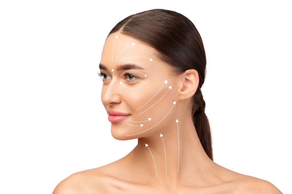 A clinical mapping diagram demonstrating the upward and outward vectors of soft tissue contraction achieved during an Endolift in Dubai.