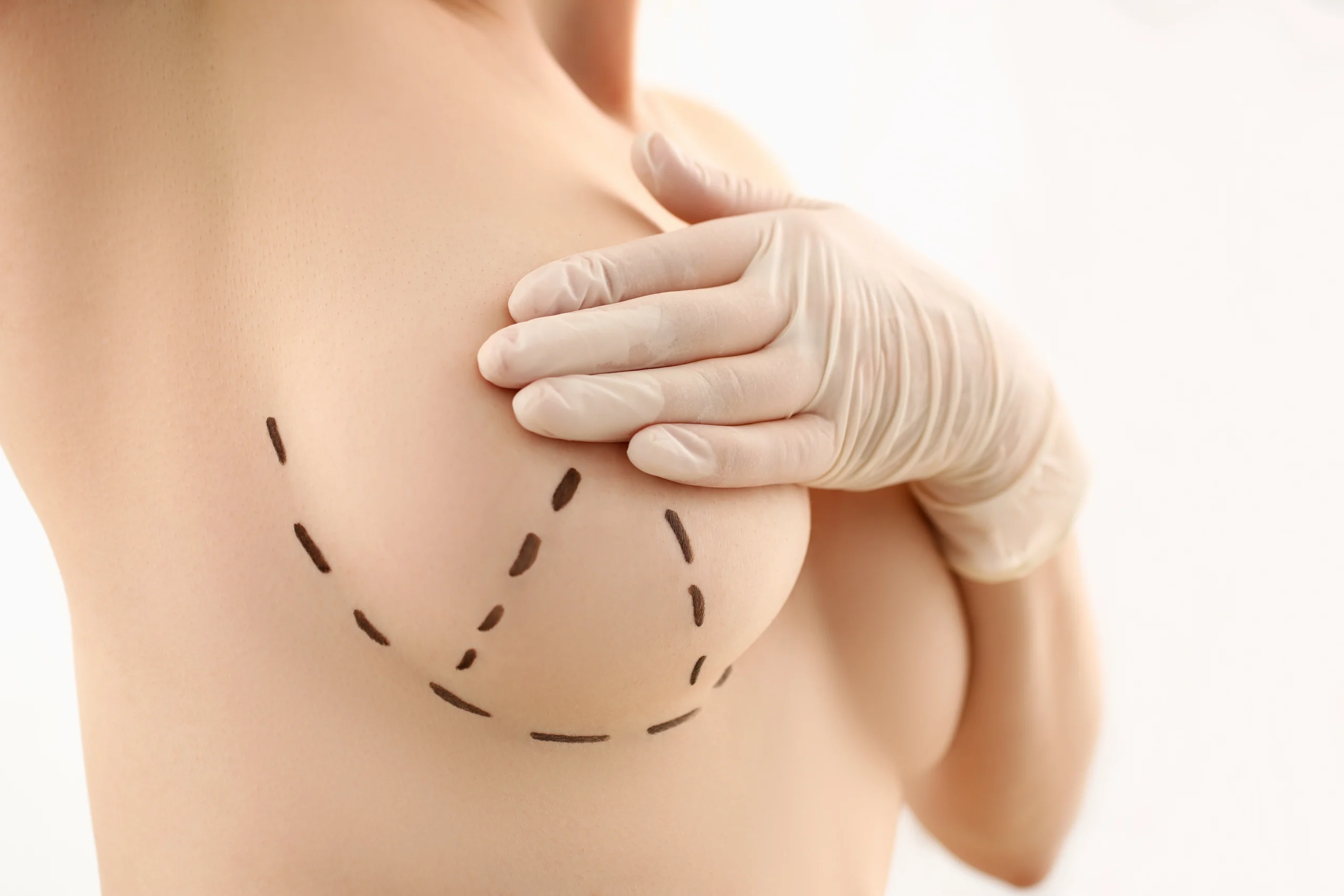 Palpation of the mammary envelope during the initial phase of Recovery After Breast Augmentation in Dubai.