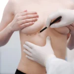 Surgeon performing clinical topographical marking of the pectoral region as part of Before and After Breast Augmentation in Dubai.