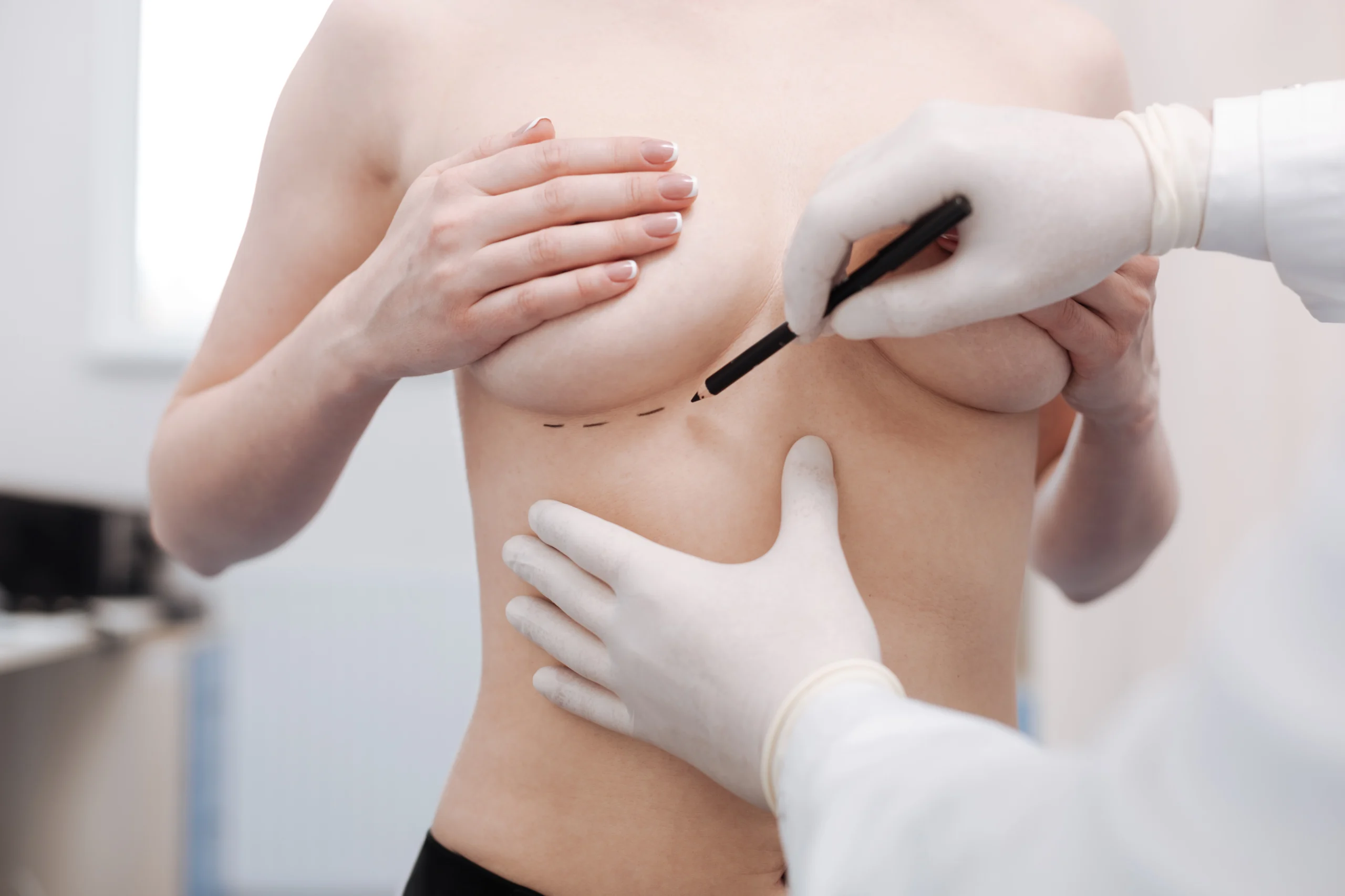 Surgeon performing clinical topographical marking of the pectoral region as part of Before and After Breast Augmentation in Dubai.