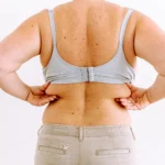 Posterior clinical assessment of subcutaneous lipodystrophy for the Ideal Candidate for Back Liposuction in Dubai.