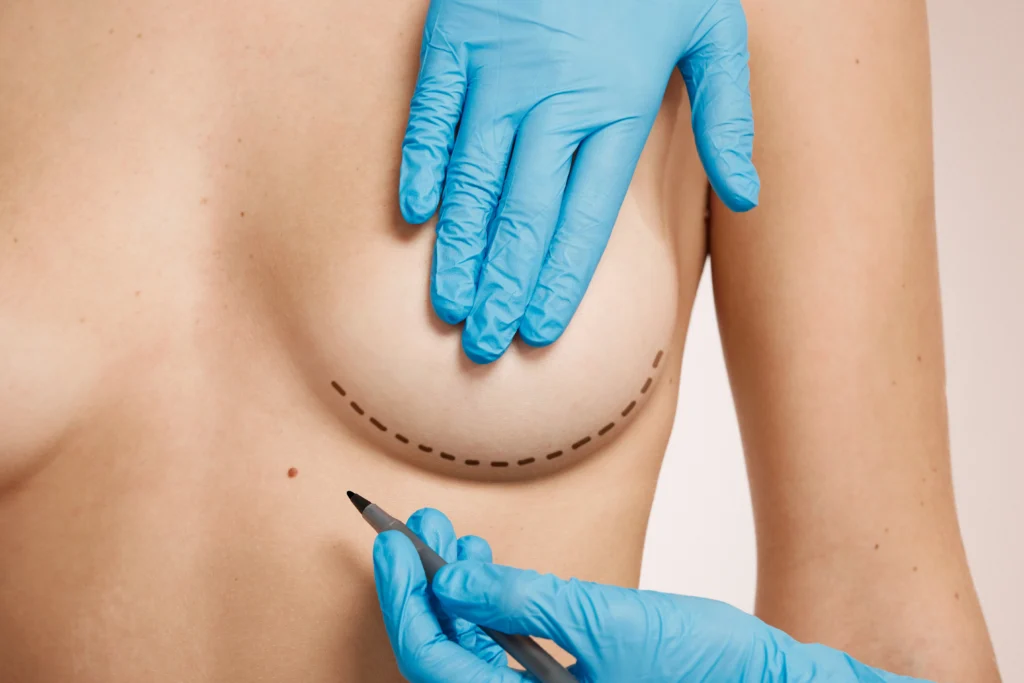 Anterior anatomical view of a female subject for Breast Augmentation in Dubai candidacy assessment.
