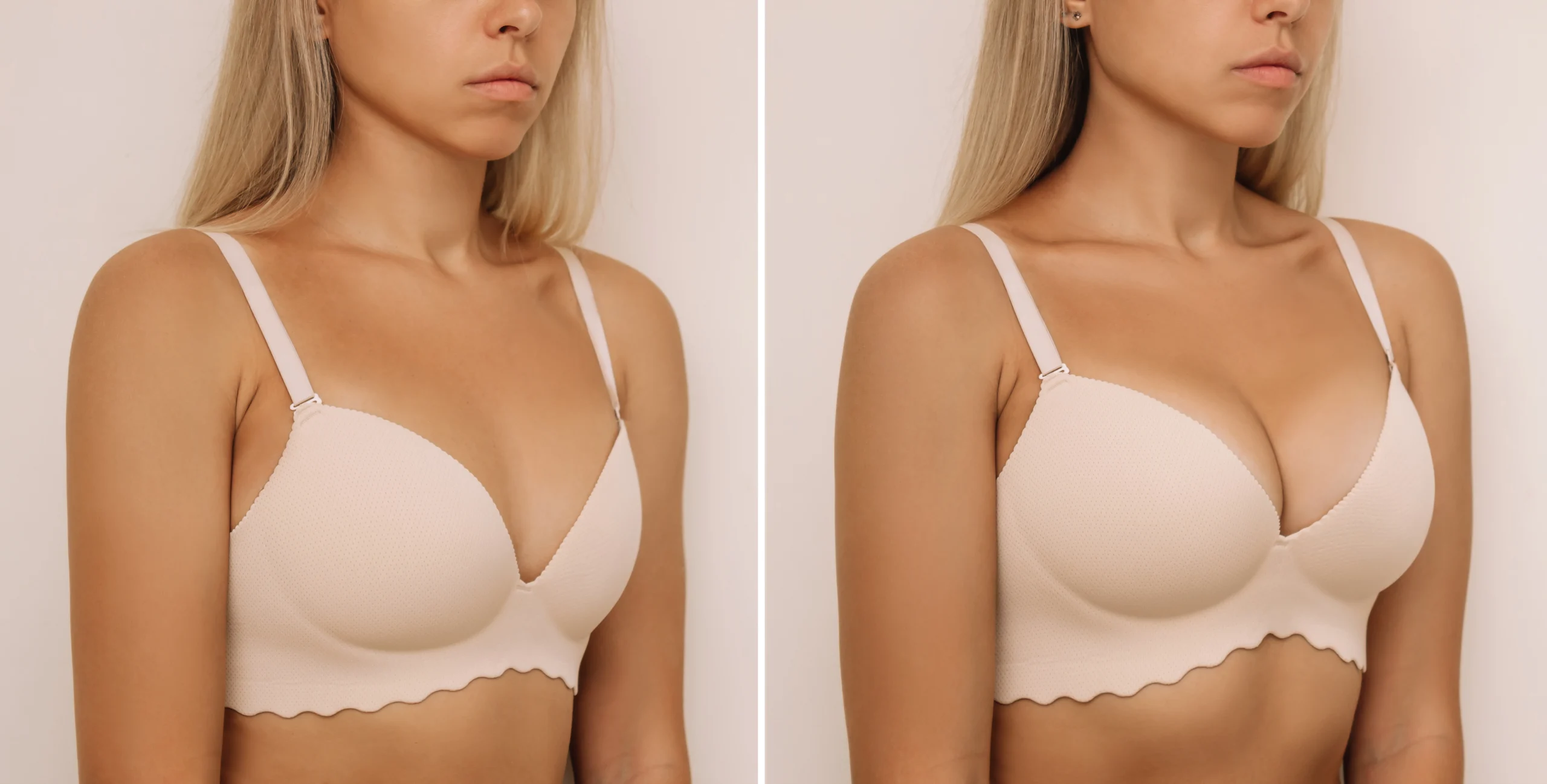 Comparative study of mammary hypoplasia vs. postoperative projection using Types of Breast Implants Used in Dubai.