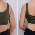 Posterior view demonstrating the resolution of thoracolumbar lipodystrophy in Before and After Back Liposuction in Dubai.