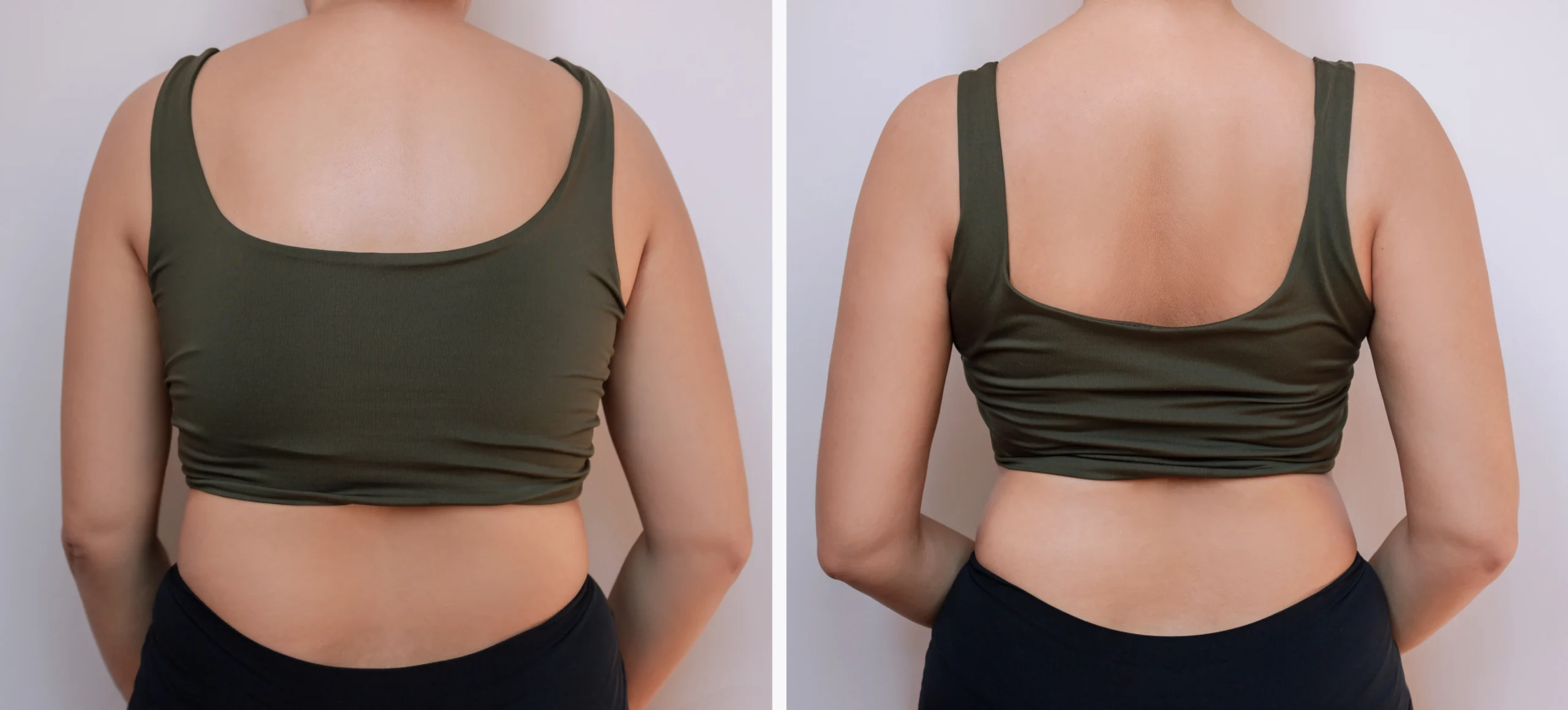 Posterior view demonstrating the resolution of thoracolumbar lipodystrophy in Before and After Back Liposuction in Dubai.