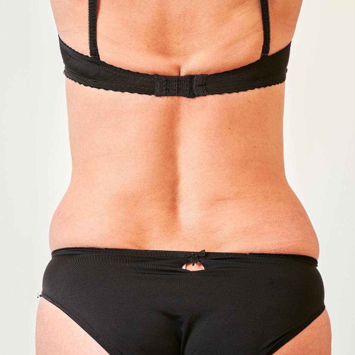 A close-up posterior view from the upper back to the hips of a woman standing in a black bra and matching black briefs against a white background, showcasing localized fat deposits and skin folds across the mid-back and flanks to establish a baseline for Back Liposuction in Dubai.