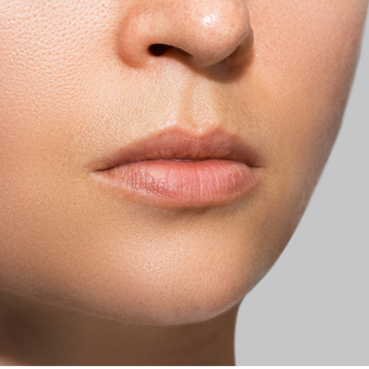 A detailed clinical close-up front view of a woman's lower face, nose, and mouth against a neutral gray background, showing an elongated distance between the base of the nose and the upper lip vermilion border prior to a Lips Lift dubai.