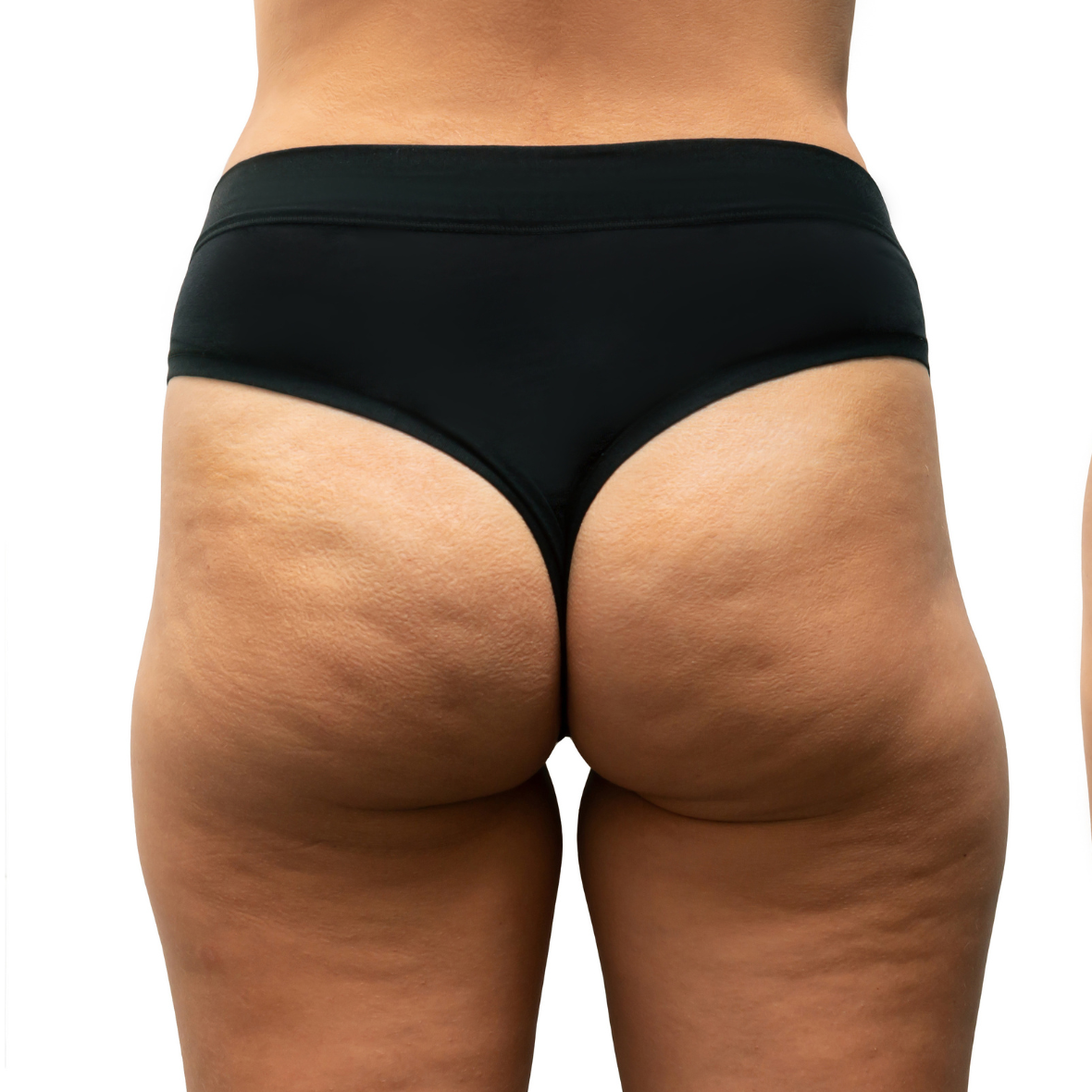 A detailed posterior close-up clinical view of a patient's lower torso, hips, and gluteal region against a solid white background, wearing black high-cut briefs, showcasing baseline tissue laxity and lateral trochanteric volume depressions prior to a Brazilian Butt Lift Dubai.