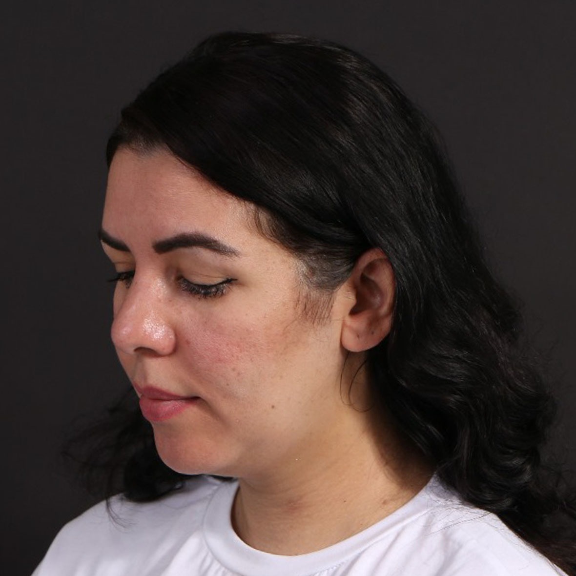 After double chin liposuction results at Cocoona Dubai