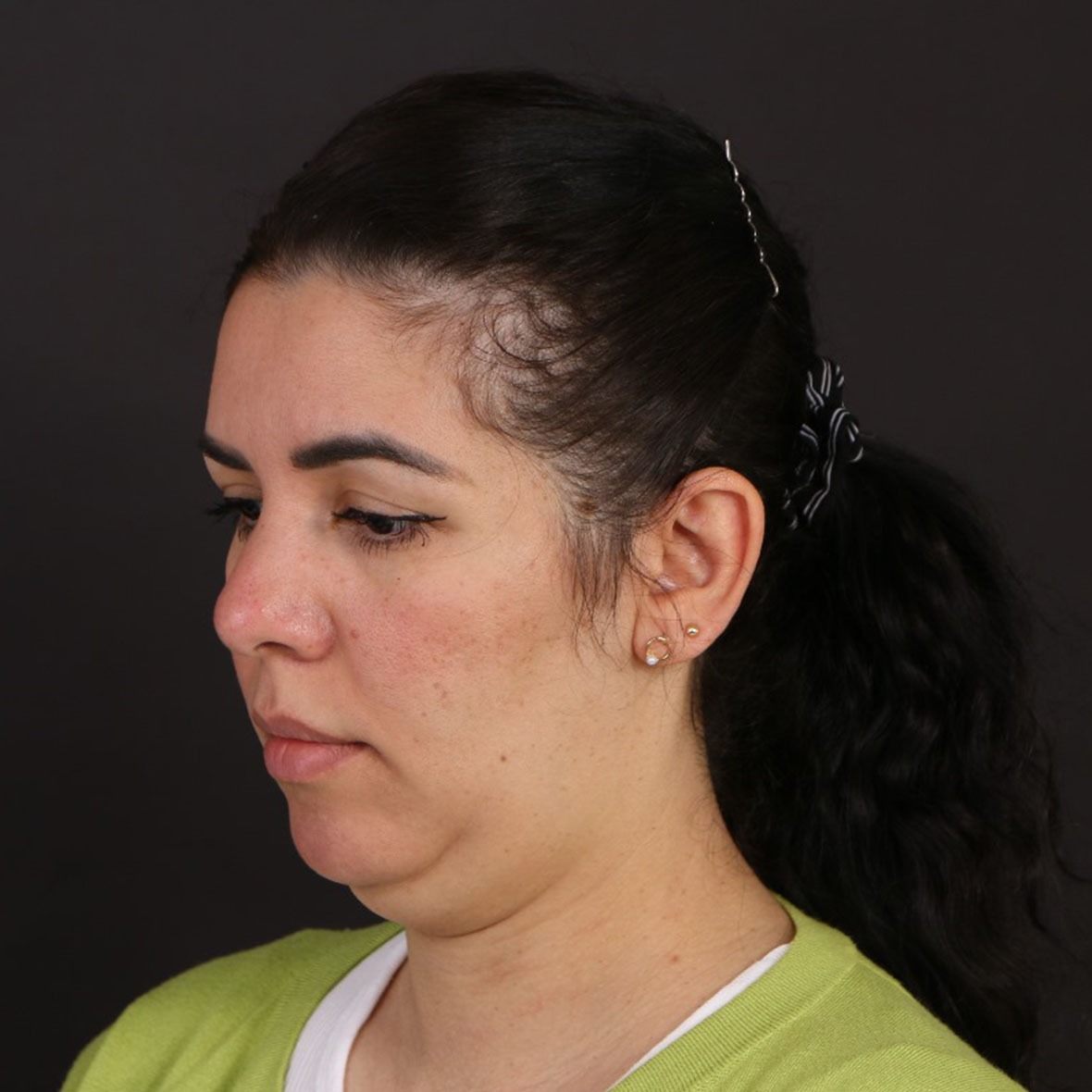 Before double chin liposuction results at Cocoona Dubai