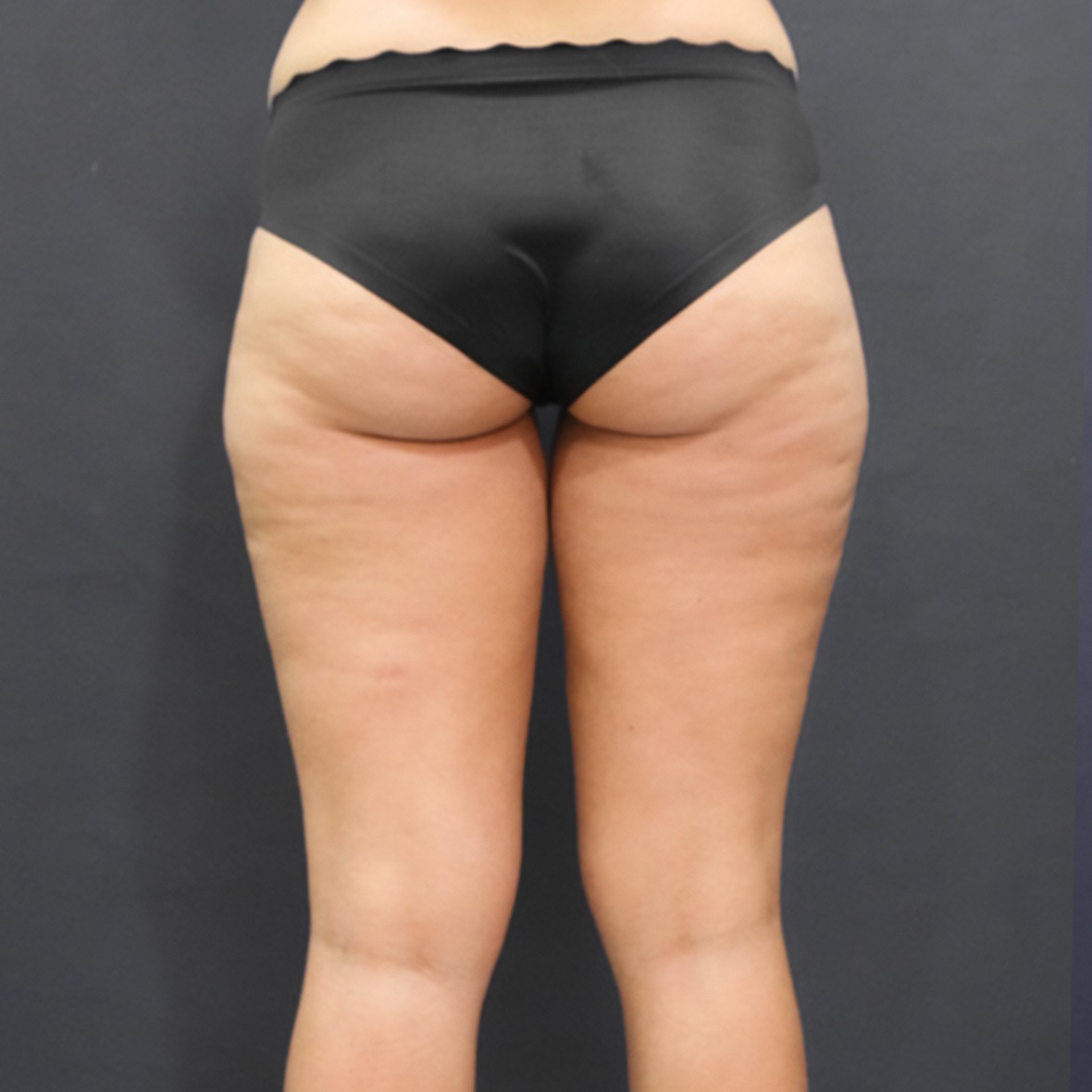A posterior close-up view from the lower waist to the mid-calves of a woman standing in black briefs against a solid dark grey background, showcasing localized fat deposits and skin texture variations on the outer thighs, inner thighs, and sub-gluteal folds to establish a baseline for Thigh Liposuction in Dubai.