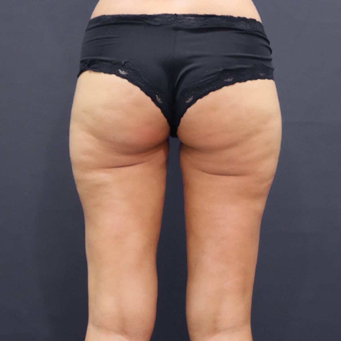 A posterior close-up view from the lower waist to the mid-calves of a woman standing in black lace-trimmed briefs against a solid dark grey background, showcasing a visibly reduced volume, enhanced gap symmetry, and smoother contours on the inner and outer thighs achieved after Thigh Liposuction in Dubai.