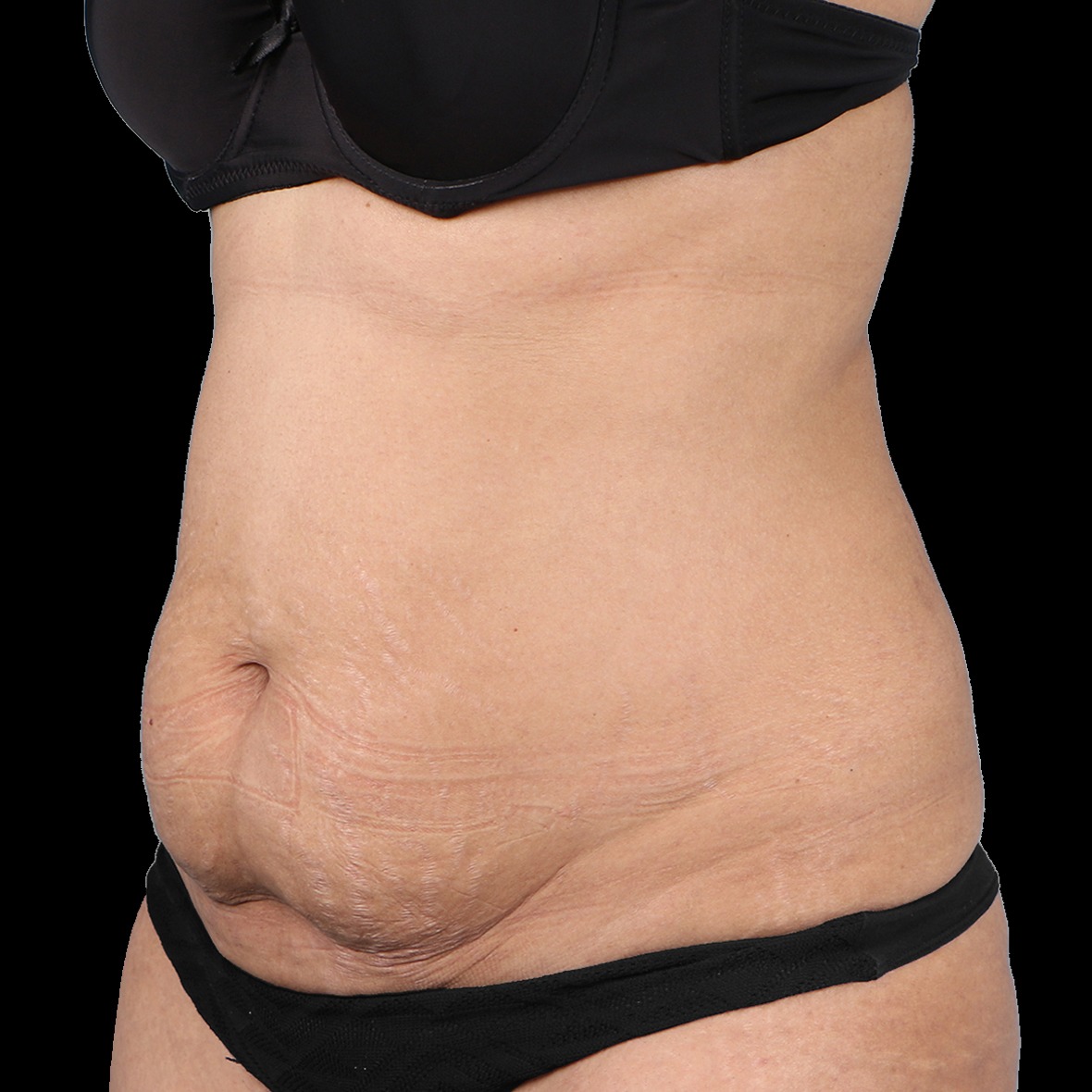 A three-quarters close-up view of a woman's torso from the lower chest to the hips against a solid black background, showcasing significant skin laxity, wrinkling, and a sagging tissue apron on the lower stomach to establish a baseline for a tummy tuck in dubai.
