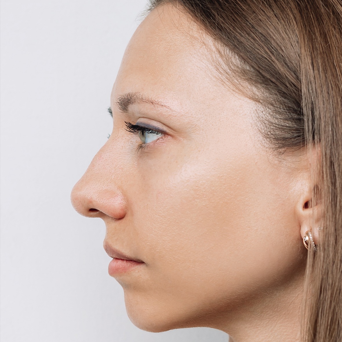 A close-up side profile shot of a woman's face from the forehead to the chin looking forward against a plain white background, showcasing a prominent hump on the nasal bridge and the baseline nasal tip rotation to establish a preoperative marker for a Rhinoplasty in Dubai.