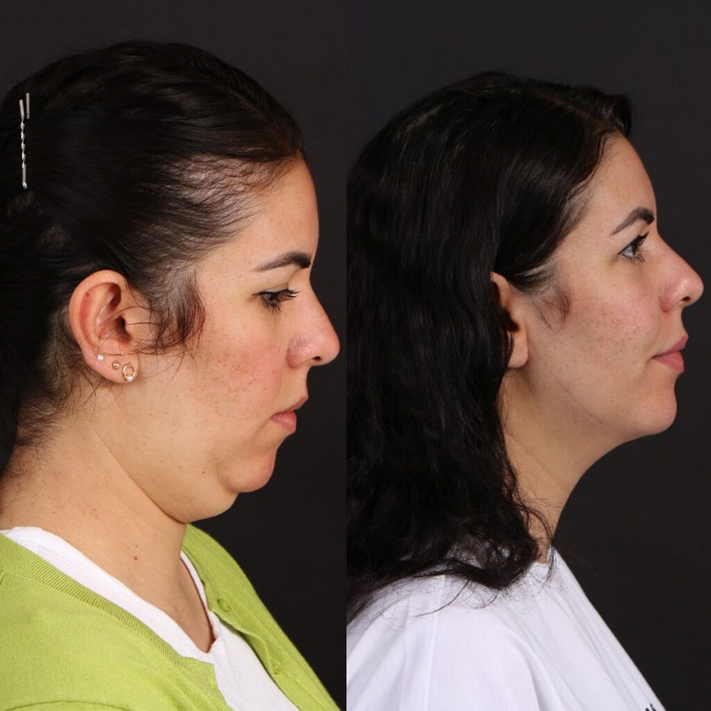 Chin-Augmentation-before-After-Treatment-Cocoona-Clinic-Dubai